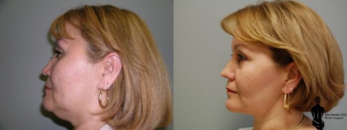 Before & After Face Lift Case 34 View #5 View in Springfield, MA