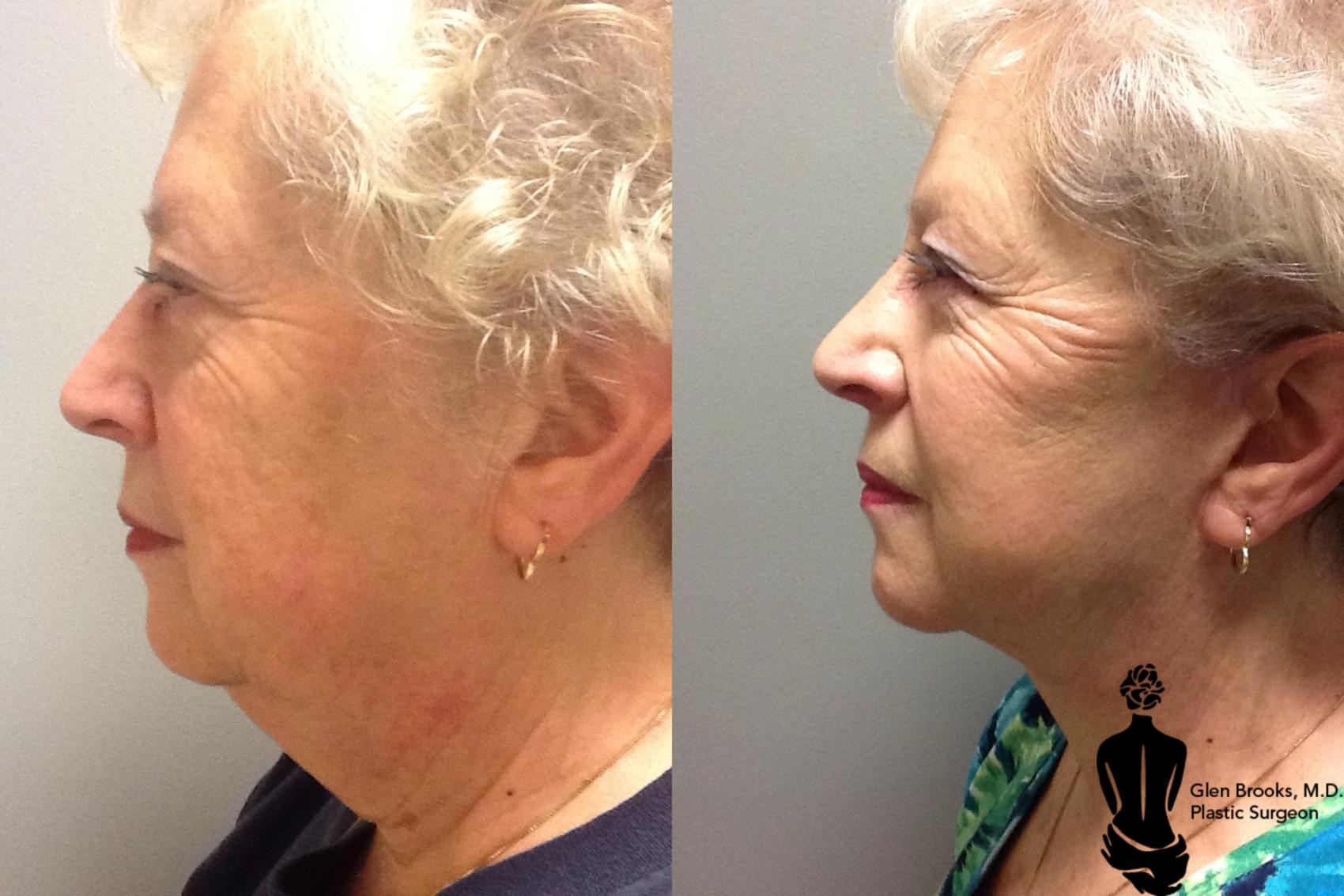 Face Lift Before & After Photo | Springfield, MA | Aesthetic Plastic & Reconstructive Surgery