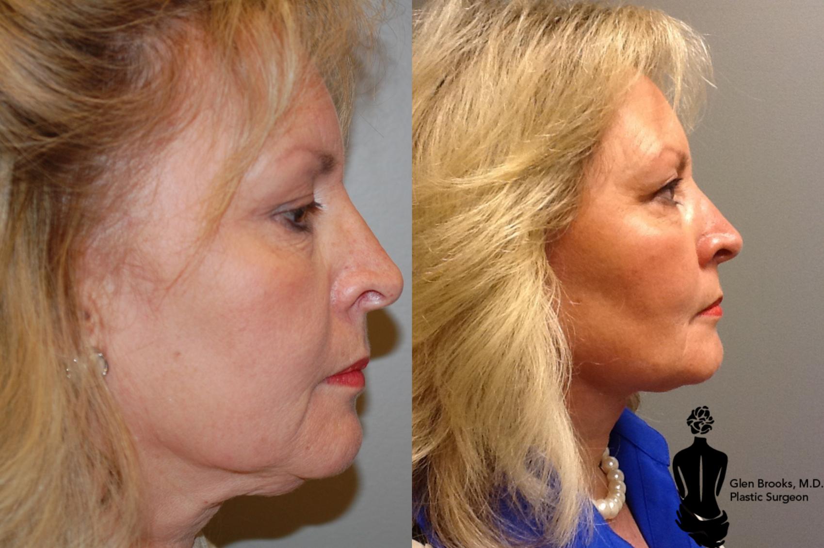 Face Lift Before & After Photo | Springfield, MA | Aesthetic Plastic & Reconstructive Surgery