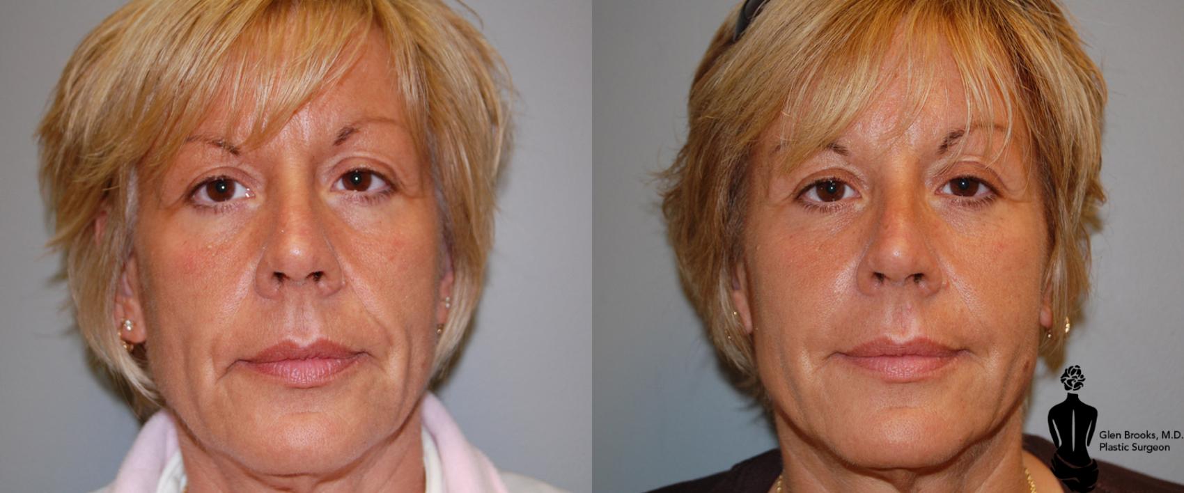 Before & After Fillers Case 12 View #1 View in Springfield, MA