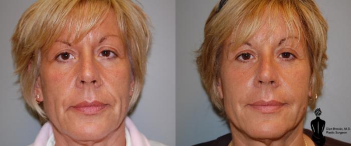 Before & After Fillers Case 12 View #1 View in Springfield, MA