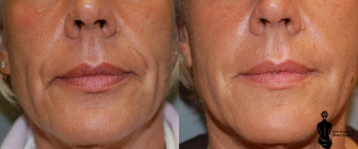 Before & After Fillers Case 12 View #2 View in Springfield, MA