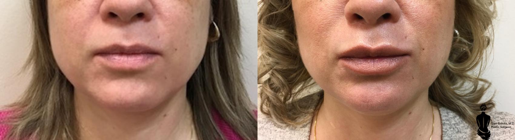 Fillers Before & After Photo | Springfield, MA | Aesthetic Plastic & Reconstructive Surgery