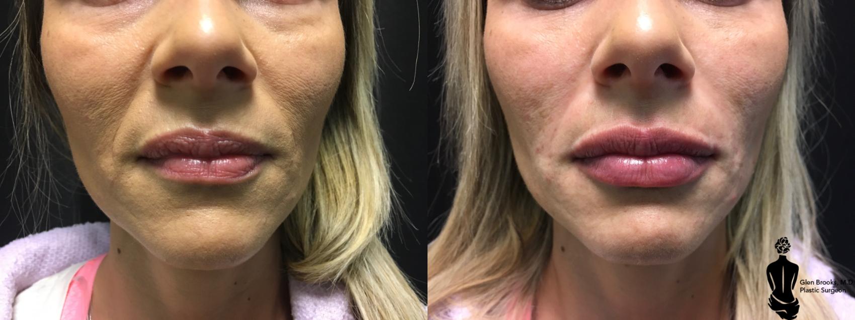 Before & After Fillers Case 149 View #1 View in Springfield, MA