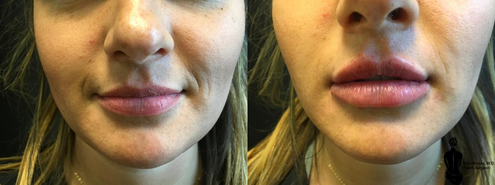 Before & After Fillers Case 152 View #1 View in Springfield, MA
