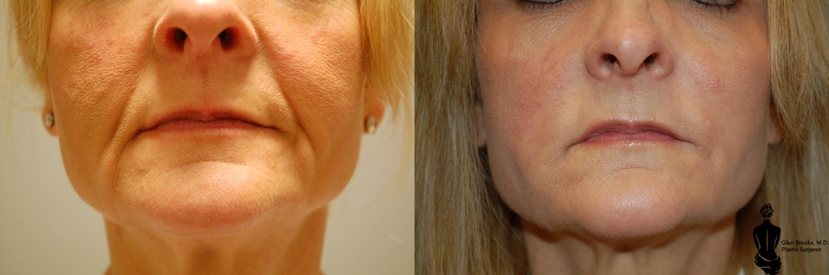 Before and After Marionette Lines Filler: A Photo FAQ