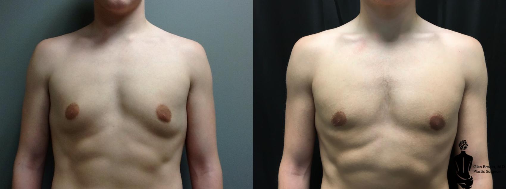 Before & After Gynecomastia Case 127 View #1 View in Springfield, MA