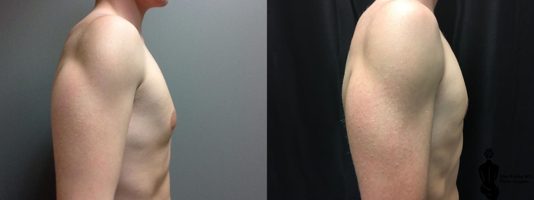 Before & After Gynecomastia Case 127 View #2 View in Springfield, MA