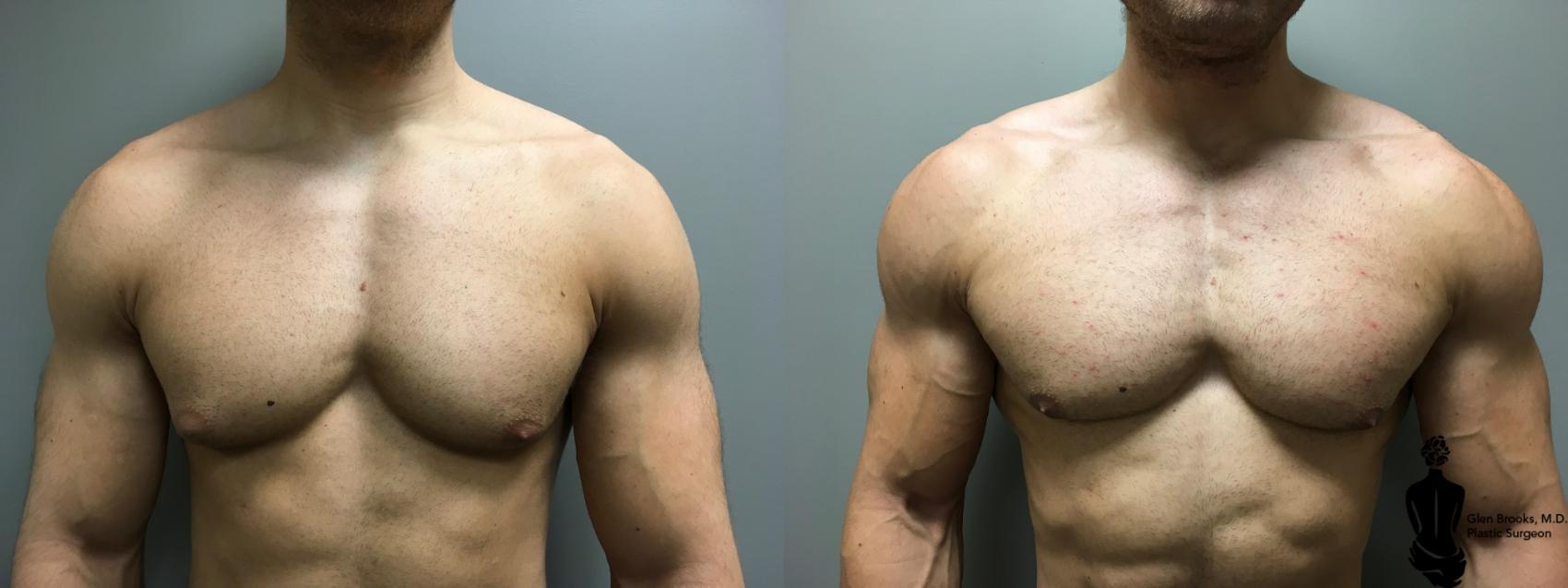 Liposuction - Male Chest Before and After Pictures Case 3