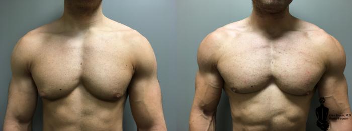 Before & After Gynecomastia Case 128 View #1 View in Springfield, MA