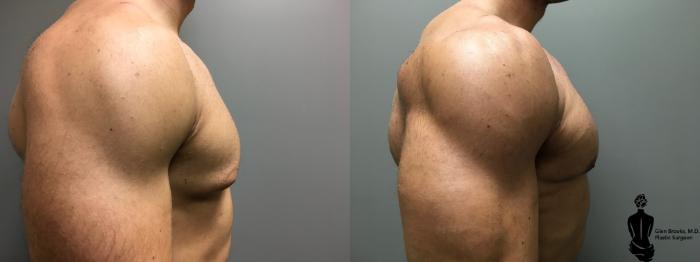 Before & After Gynecomastia Case 128 View #2 View in Springfield, MA