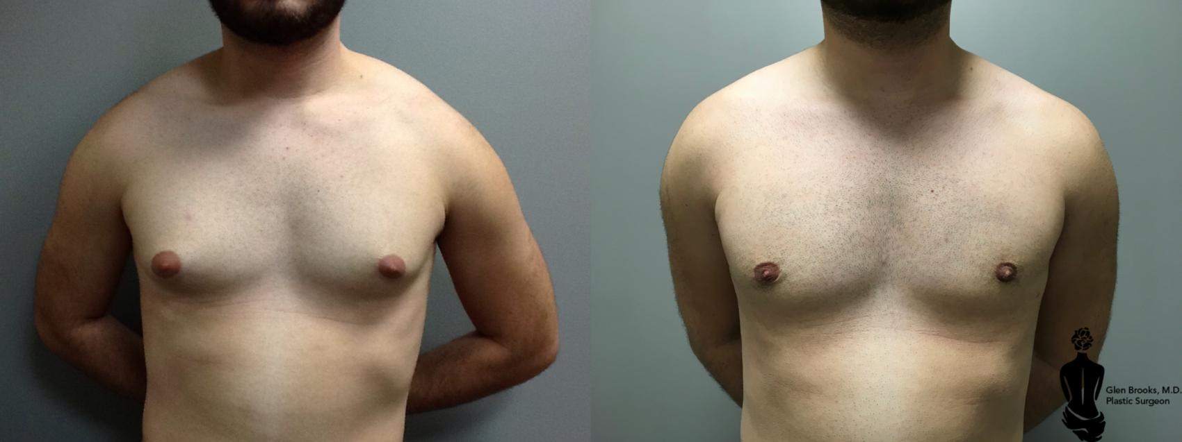 Before & After Gynecomastia Case 129 View #1 View in Springfield, MA