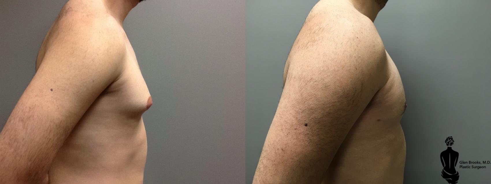 Before & After Gynecomastia Case 129 View #2 View in Springfield, MA