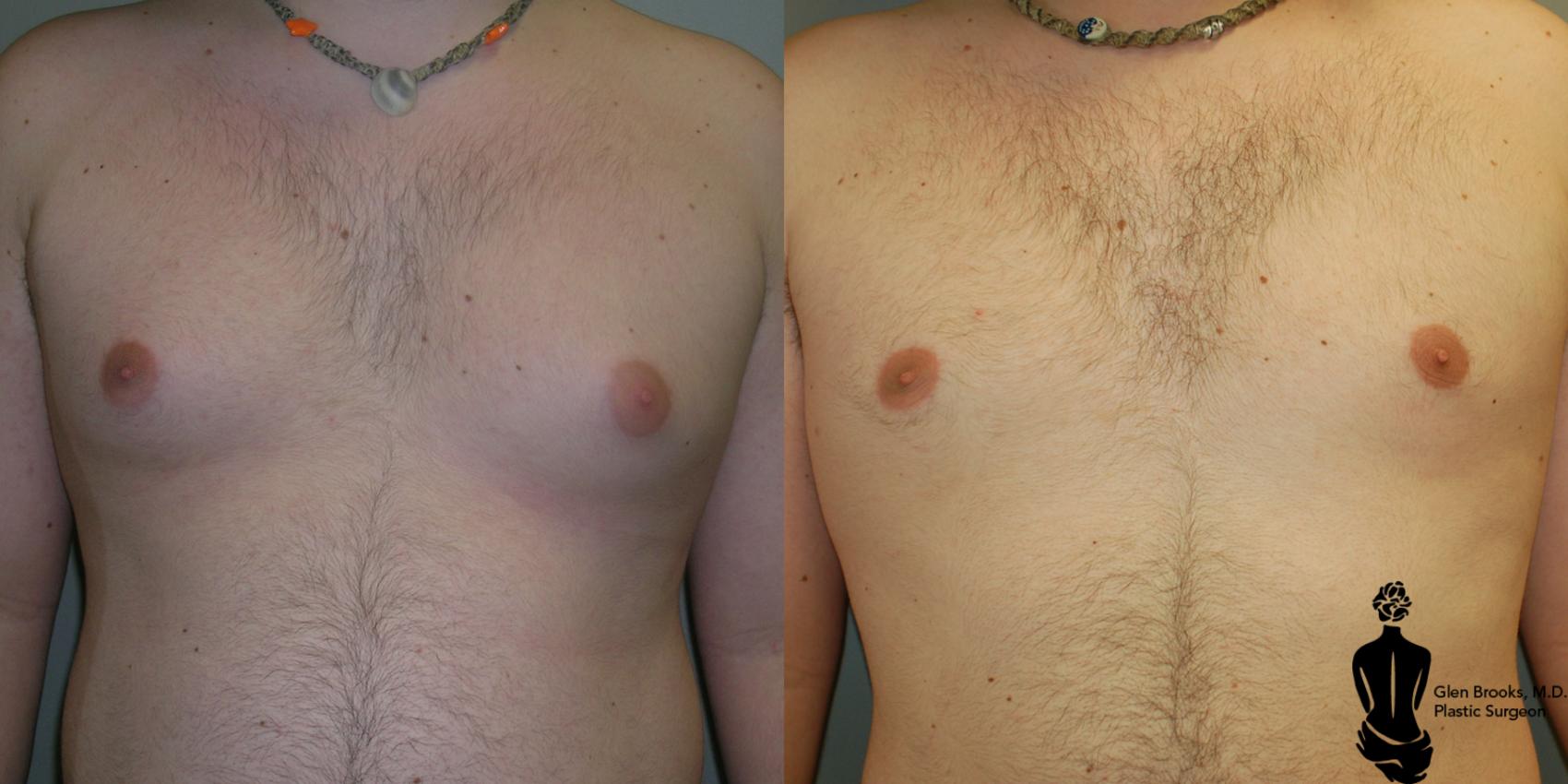Before & After Gynecomastia Case 13 View #1 View in Springfield, MA