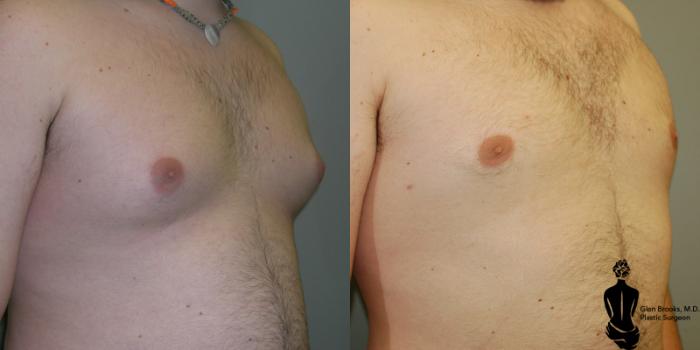 Before & After Gynecomastia Case 13 View #2 View in Springfield, MA