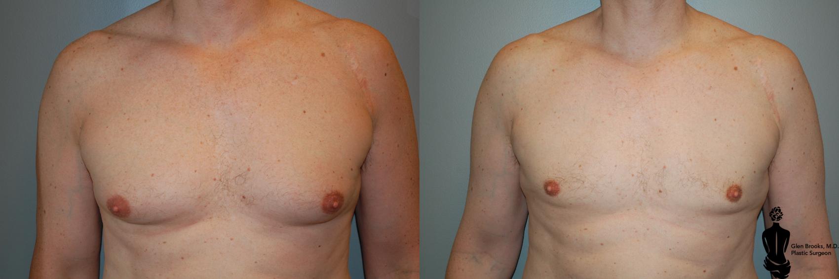 Male Breast Reduction in Springfield MA