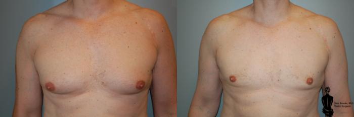 Before & After Gynecomastia Case 66 View #1 View in Springfield, MA