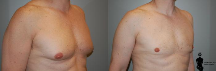 Before & After Gynecomastia Case 66 View #2 View in Springfield, MA