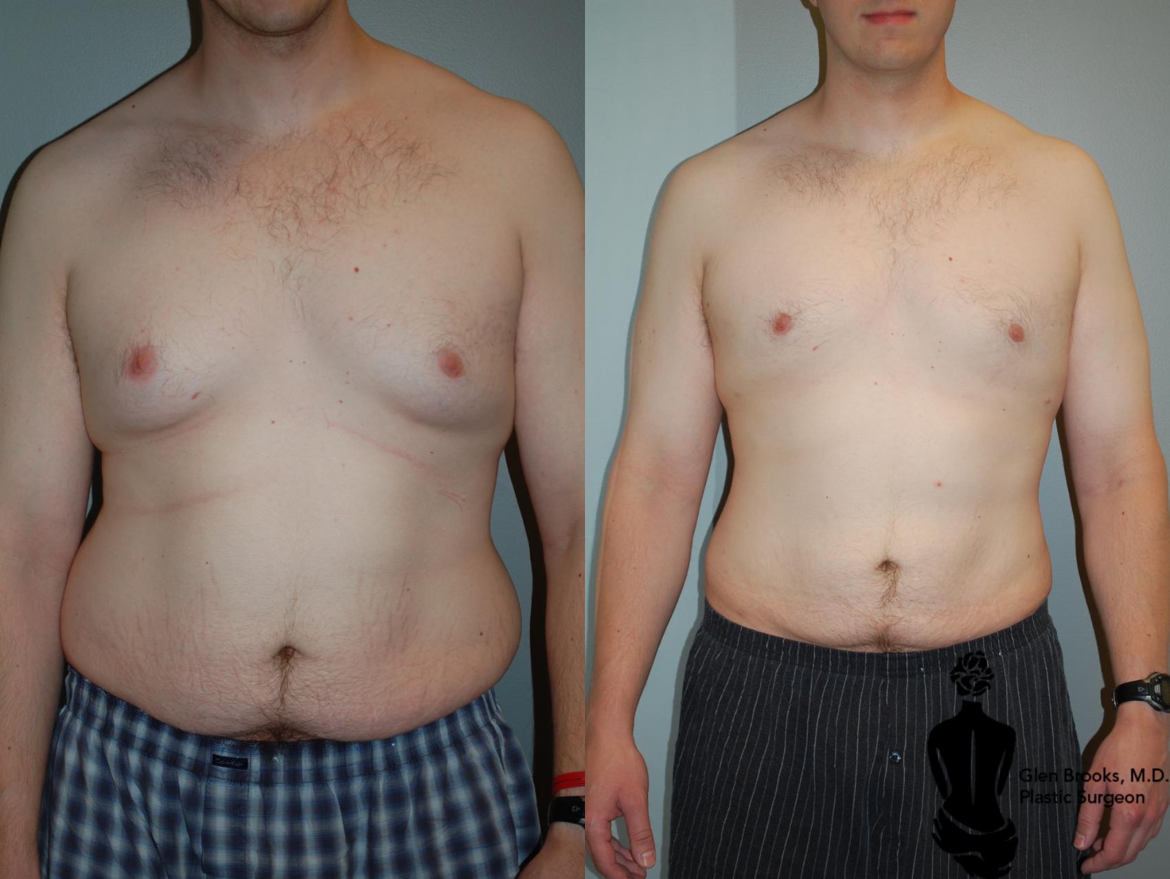 Before & After Gynecomastia Case 67 View #1 View in Springfield, MA