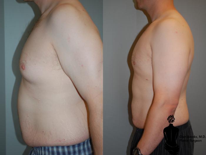 Before & After Gynecomastia Case 67 View #2 View in Springfield, MA