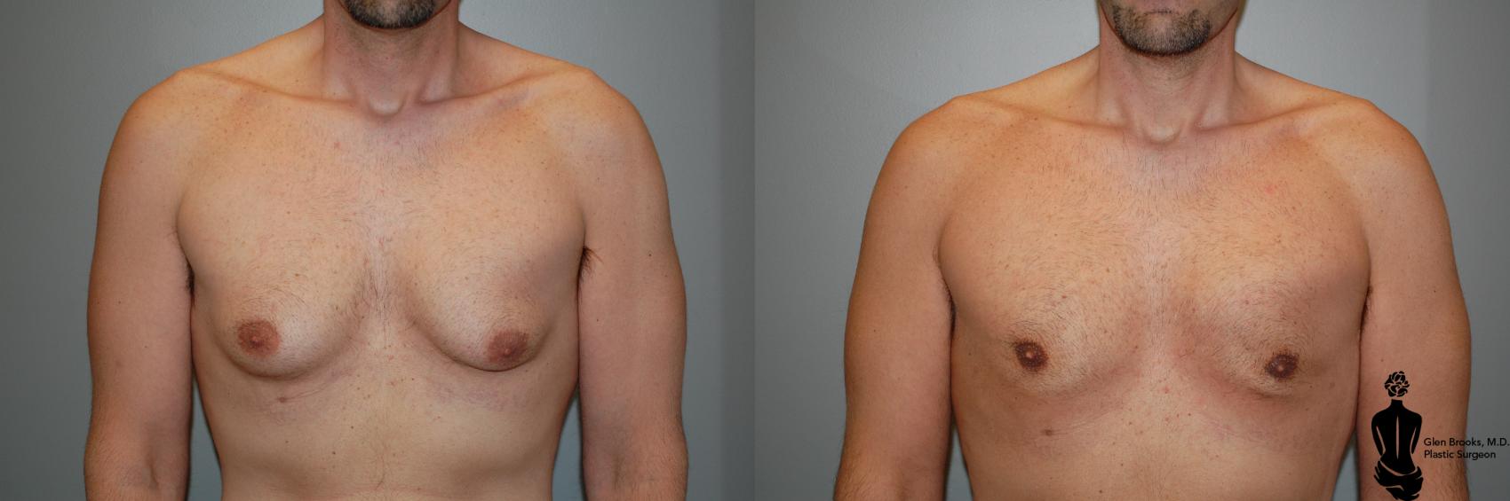 Gynecomastia Before & After, Case 10