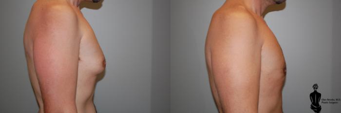 Before & After Gynecomastia Case 85 View #2 View in Springfield, MA