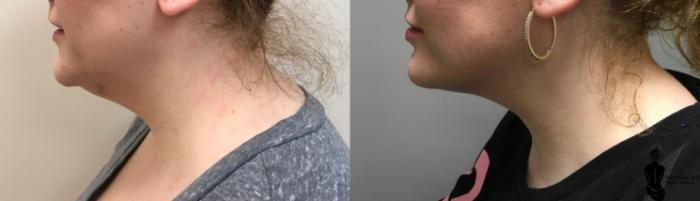 Before & After Kybella Case 124 View #1 View in Springfield, MA
