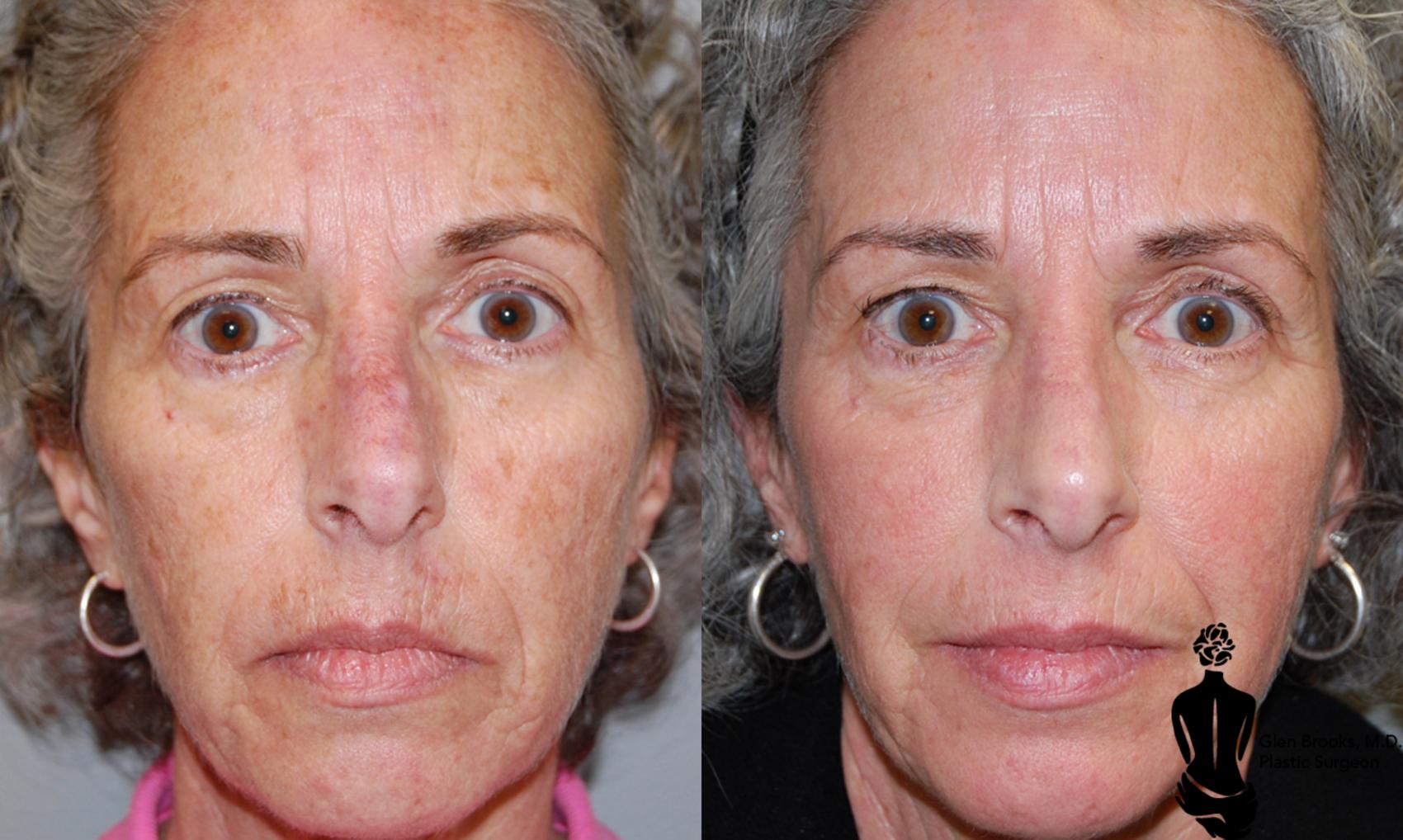 Before & After Laser Resurfacing Case 14 View #1 View in Springfield, MA