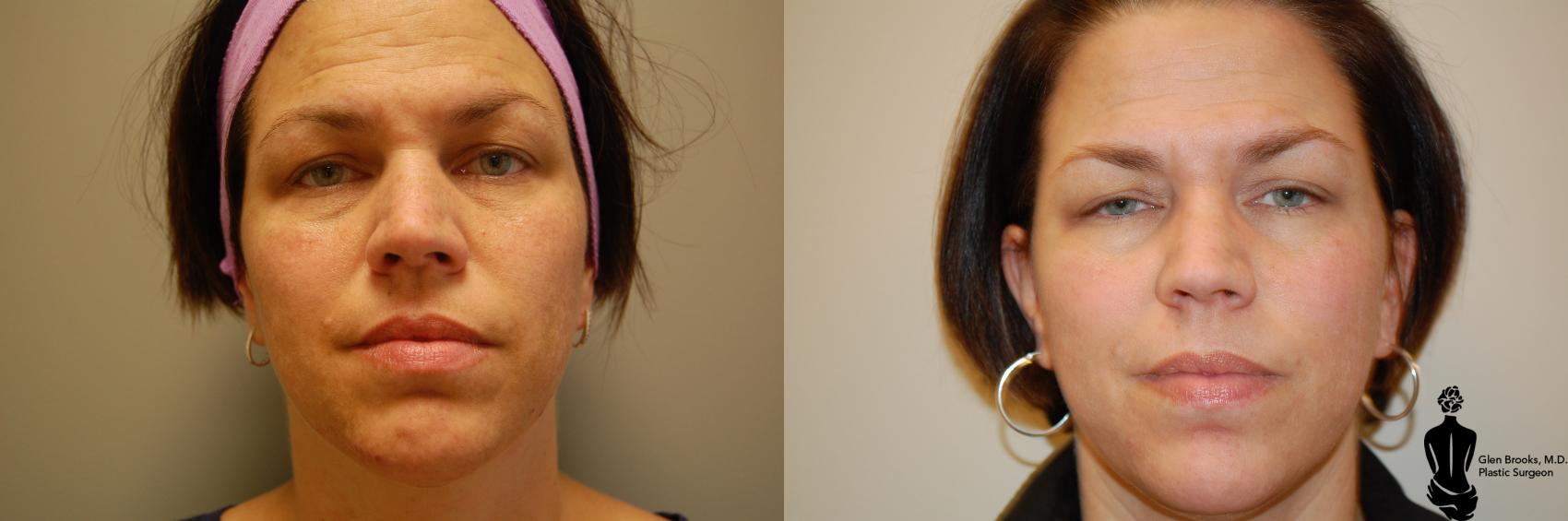 Laser Resurfacing Before & After Photo | Springfield, MA | Aesthetic Plastic & Reconstructive Surgery
