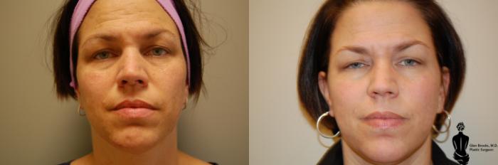Before & After Laser Resurfacing Case 37 View #1 View in Springfield, MA