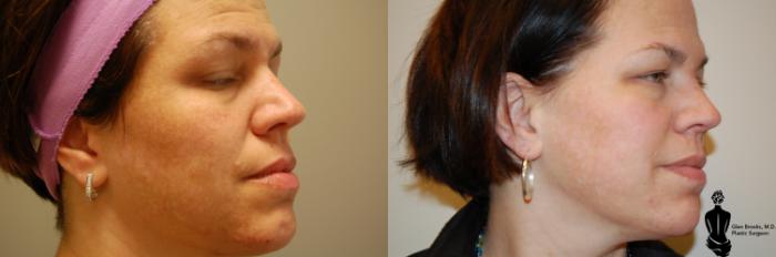 Before & After Laser Resurfacing Case 37 View #2 View in Springfield, MA