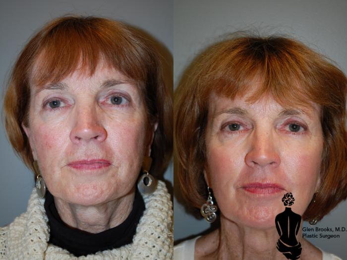 Before & After Laser Resurfacing Case 69 View #1 View in Springfield, MA