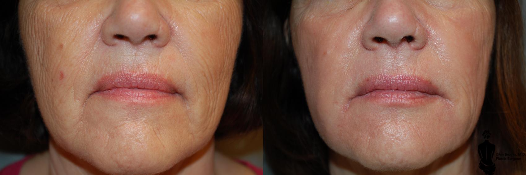 Before & After Laser Resurfacing Case 70 View #1 View in Springfield, MA