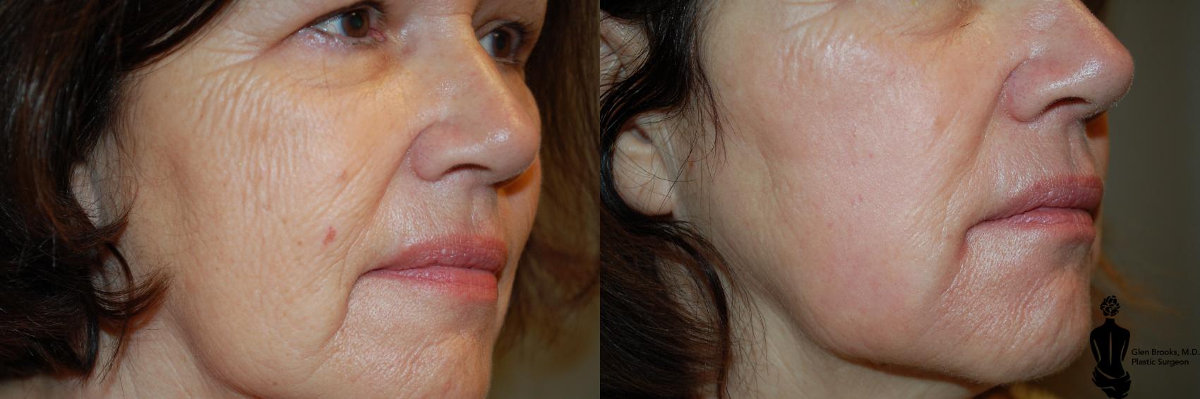 Laser Resurfacing Before & After Photo | Springfield, MA | Aesthetic Plastic & Reconstructive Surgery
