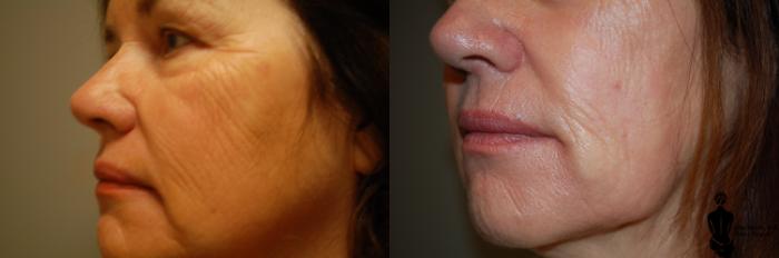 Before & After Laser Resurfacing Case 70 View #3 View in Springfield, MA