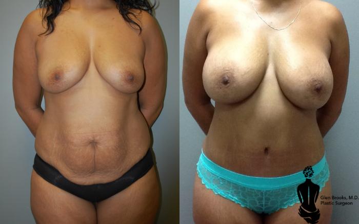Before & After Liposuction Case 106 View #1 View in Springfield, MA