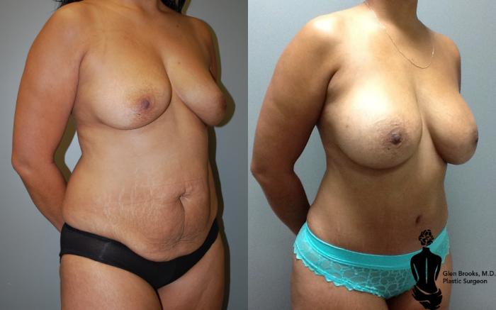 Before & After Liposuction Case 106 View #2 View in Springfield, MA