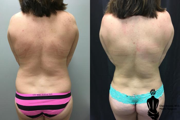 Before & After Liposuction Case 125 View #1 View in Springfield, MA
