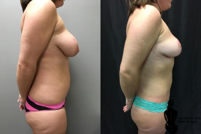 Before & After Liposuction Case 125 View #2 View in Springfield, MA