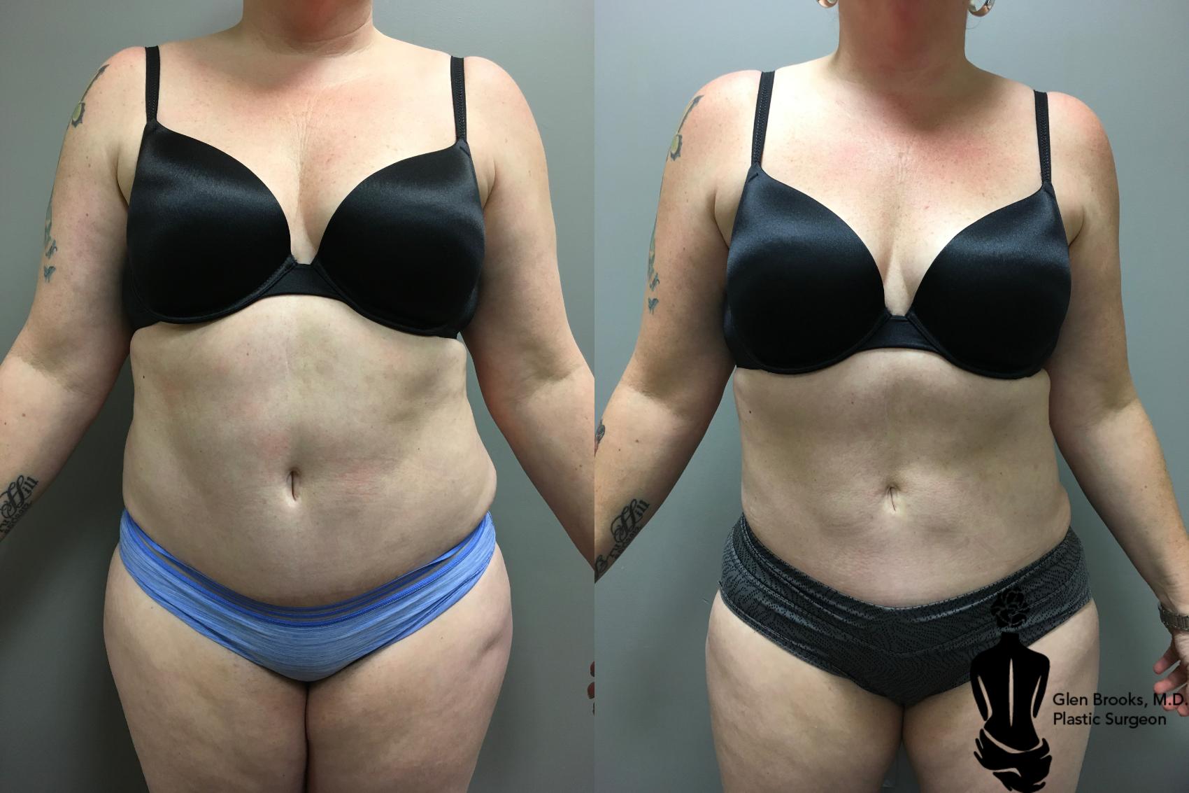 Before & After Liposuction Case 130 View #1 View in Springfield, MA