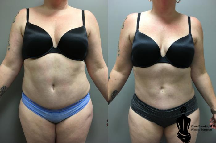 Before & After Liposuction Case 130 View #1 View in Springfield, MA