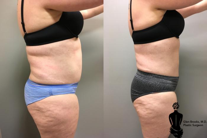 Before & After Liposuction Case 130 View #2 View in Springfield, MA
