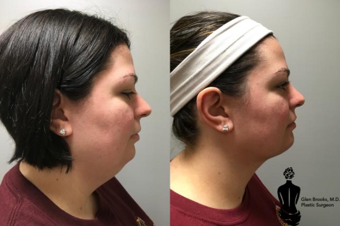 Before & After Liposuction Case 131 View #1 View in Springfield, MA