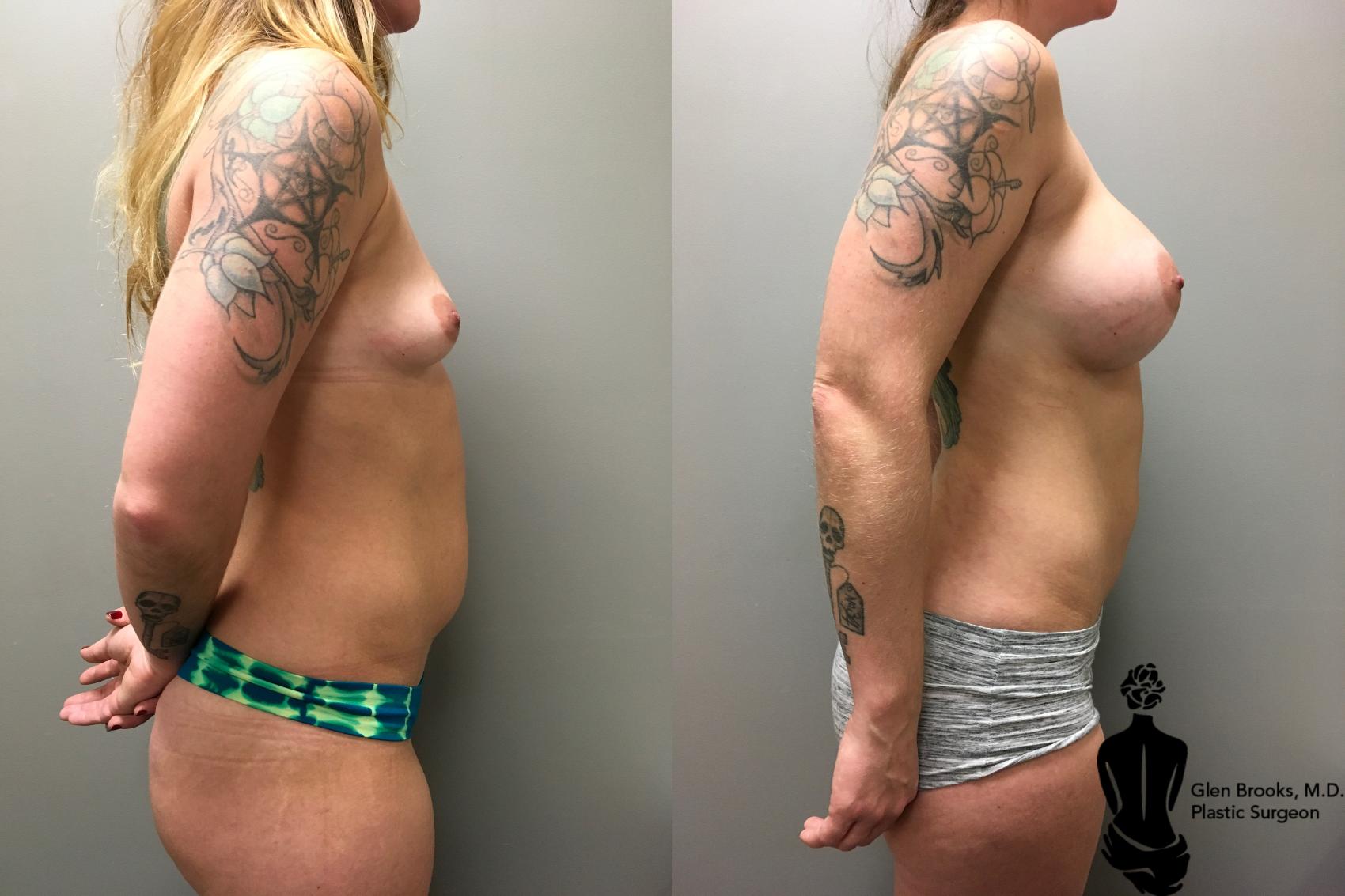 Before & After Liposuction Case 133 View #2 View in Springfield, MA