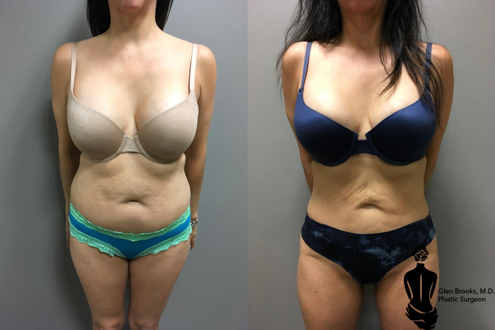 Liposuction Before & After Photo | Springfield, MA | Aesthetic Plastic & Reconstructive Surgery
