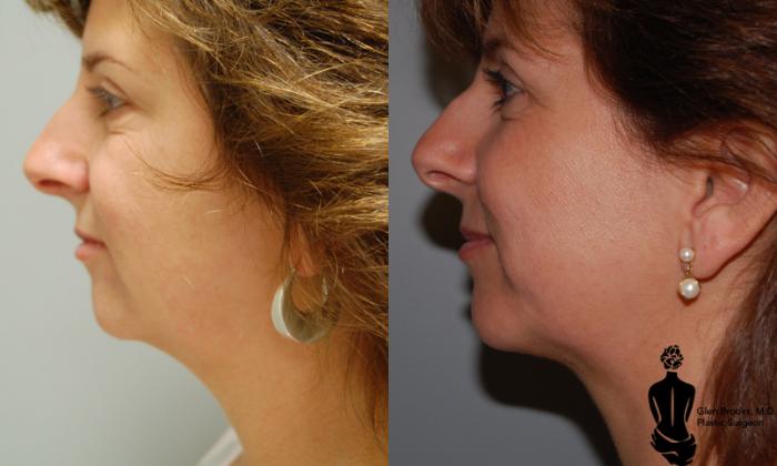 Before & After Liposuction Case 15 View #2 View in Springfield, MA