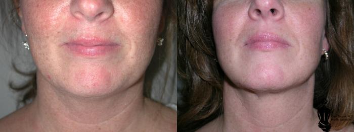 Before & After Liposuction Case 19 View #1 View in Springfield, MA