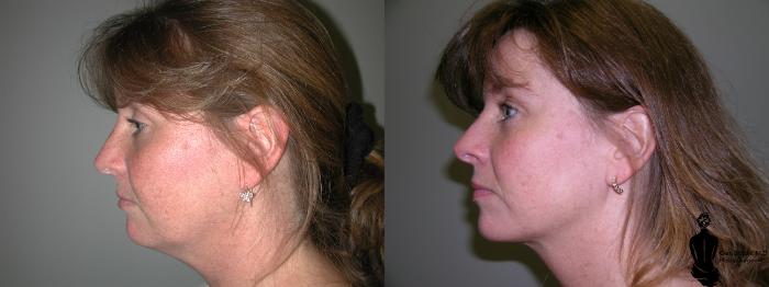 Before & After Liposuction Case 19 View #2 View in Springfield, MA