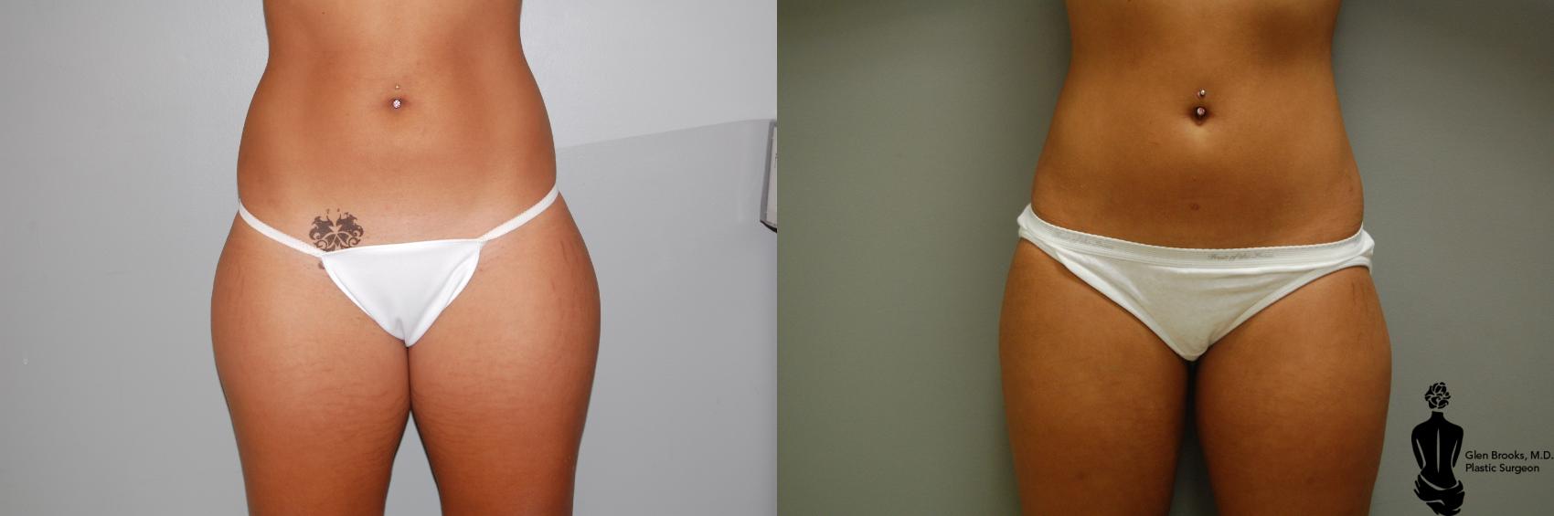 Before & After Liposuction Case 20 View #1 View in Springfield, MA