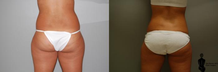 Before & After Liposuction Case 20 View #2 View in Springfield, MA